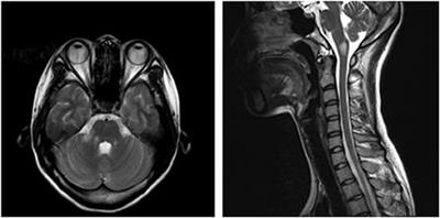 Autoimmune Glial Fibrillary Acidic Protein Astrocytopathy Associated With Area Postrema Syndrome: A Case Report